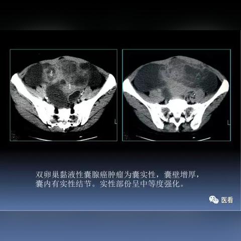 最新CT机技术革新引领医学影像新时代