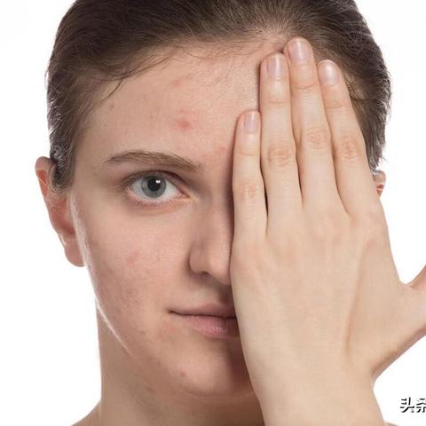 银屑病口服药物最新研究进展，创新药物概览