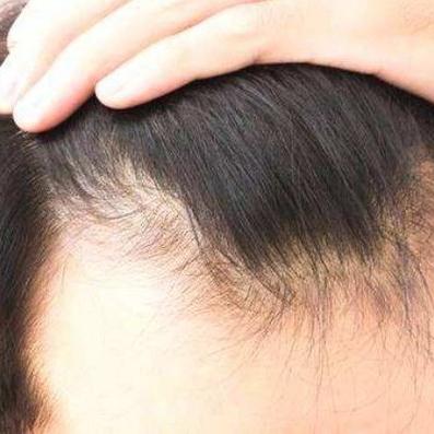 最新生发药物研究进展与应用概述